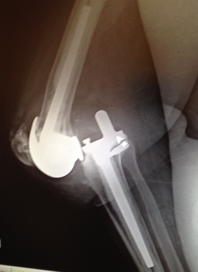 Link Endo Rotational Knee (Implant 1509112)